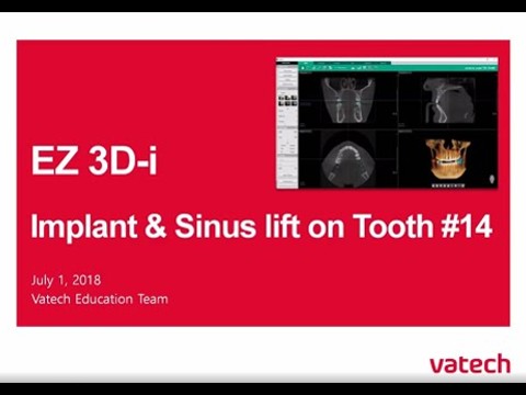 Implant (Sinus - Tooth #14)