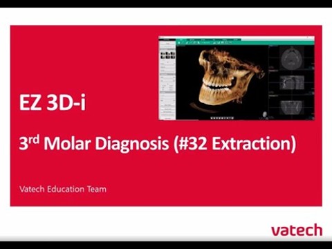 3rd Molar Diagnosis (32 Extraction Case)