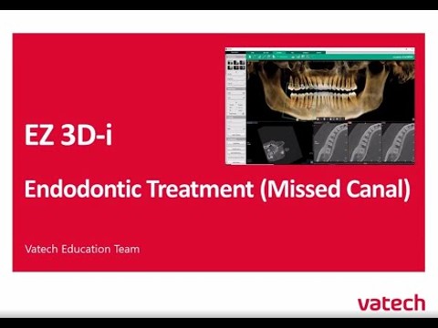 Endo Treatment (Missed Canal)