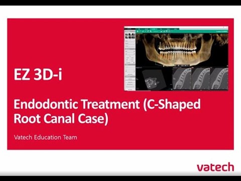 Endo Treatment (C-Shaped Root)